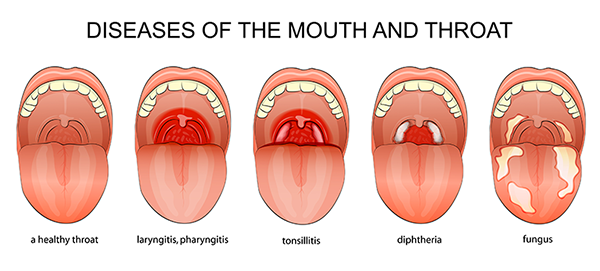 ασθένειες λαιμού και στόματος